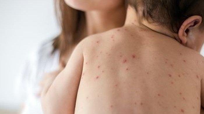 Dokter, Mitos Apa Saja yang Harus Dibantah tentang Vaksin Campak?